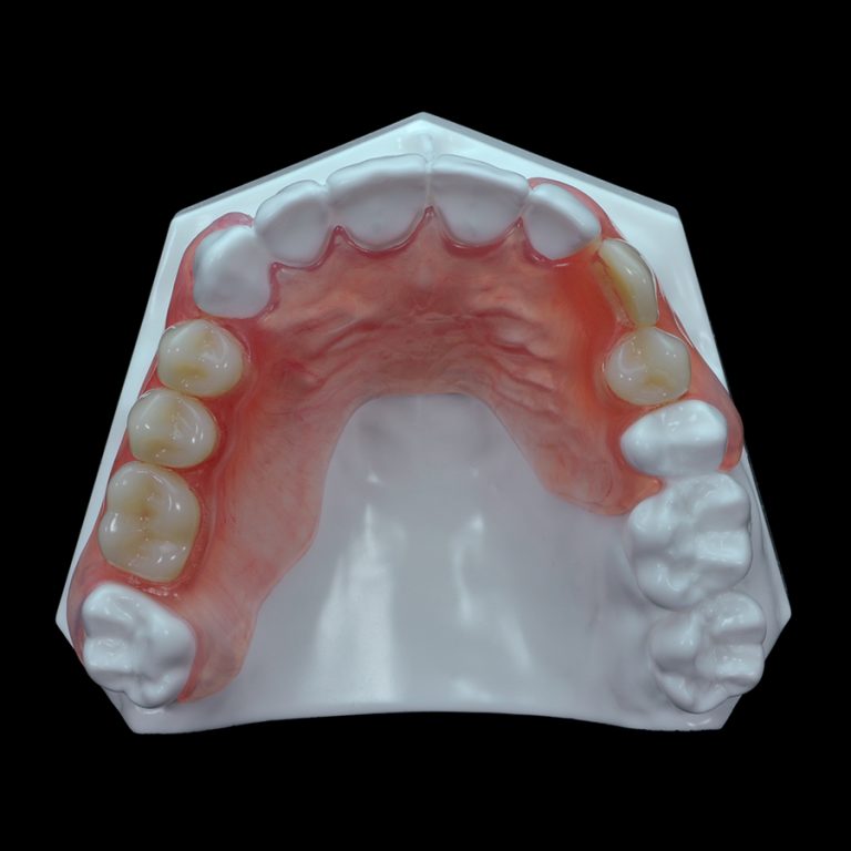 Gd 07 Flexible Partial Upper Denture Paradigm Dental Models