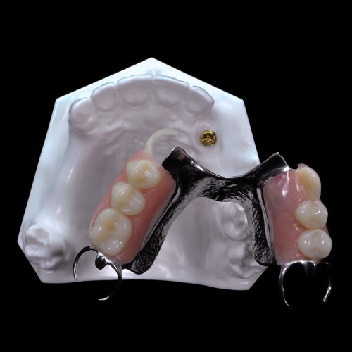 IM15 Locator Horseshoe Overdenture Paradigm Dental Models