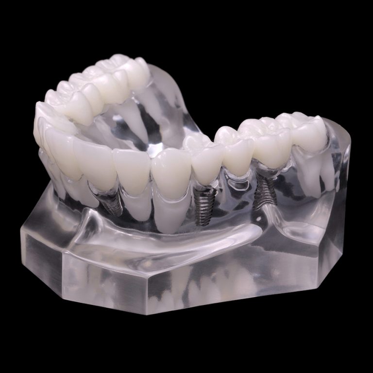 IM-03 Implant Crown and Bridge Combination | Paradigm Dental Models