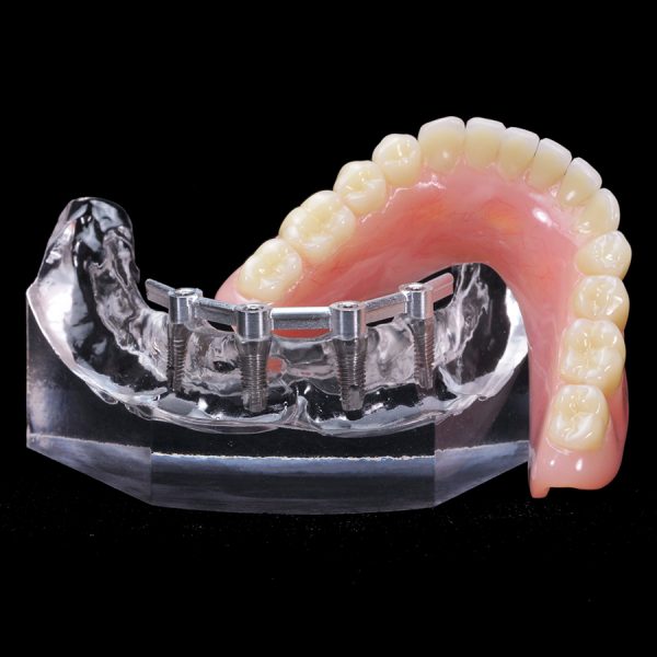 IM-01 Locator Overdenture | Paradigm Dental Models