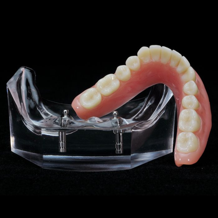 IM-13 Locator Horseshoe Overdenture with Metal Framework | Paradigm ...