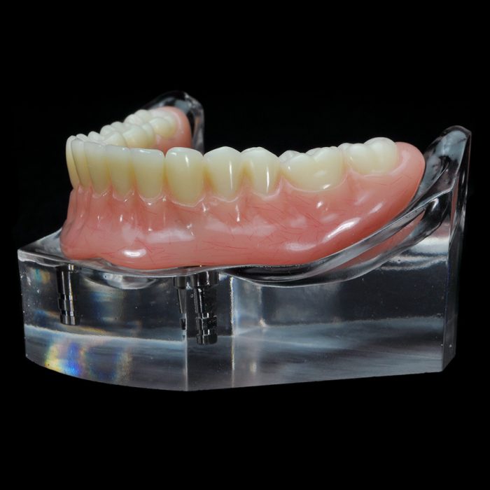 IM-09 Ball and O-Ring | Paradigm Dental Models