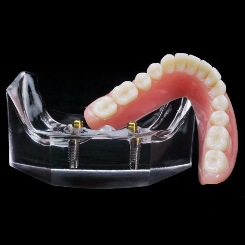 Im-13 Locator Horseshoe Overdenture With Metal Framework 