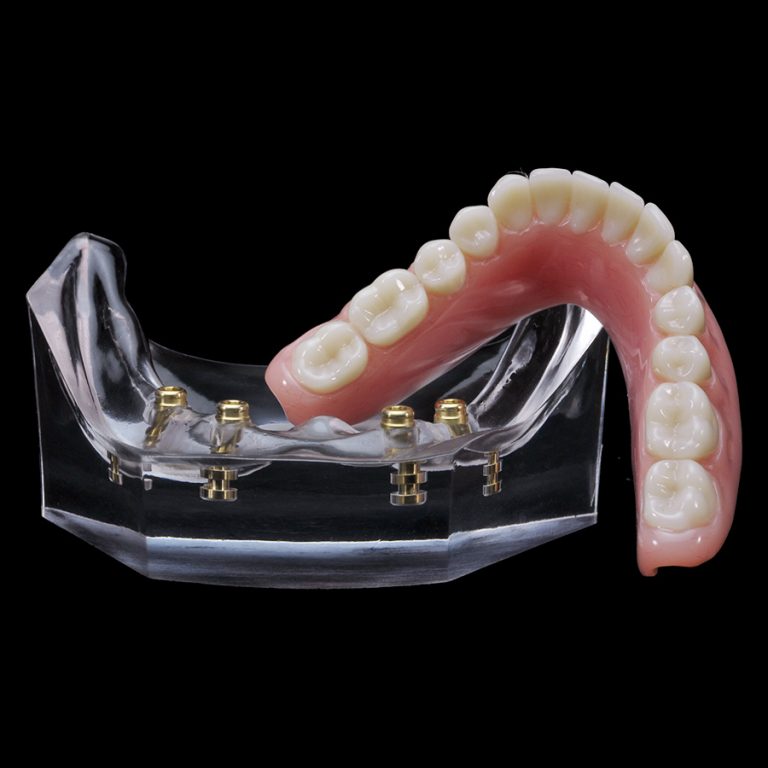 IM-08 Hader Bar | Paradigm Dental Models