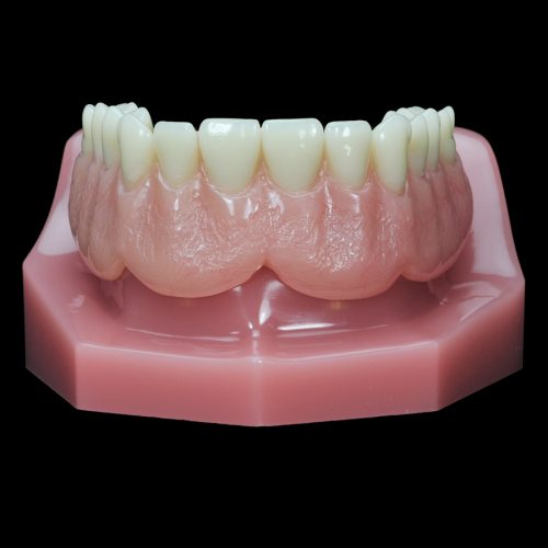 IM-13 Locator Horseshoe Overdenture with Metal Framework | Paradigm ...