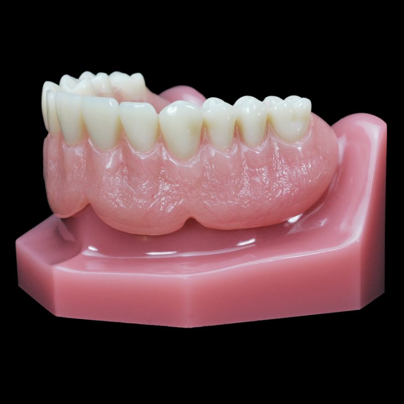 IM-13 Locator Horseshoe Overdenture with Metal Framework | Paradigm ...