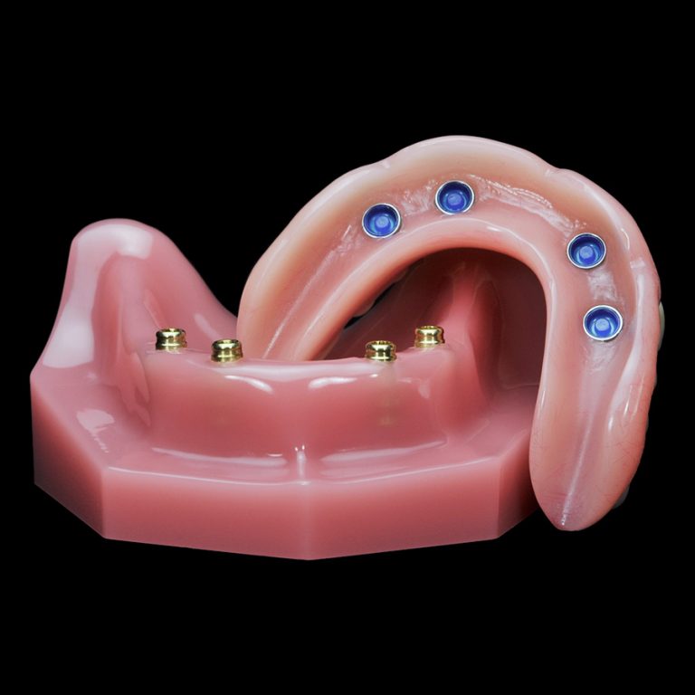 IM-15 Locator Horseshoe Overdenture | Paradigm Dental Models