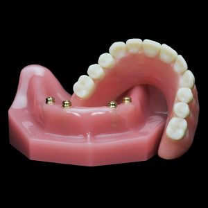 IM-15 Locator Horseshoe Overdenture | Paradigm Dental Models