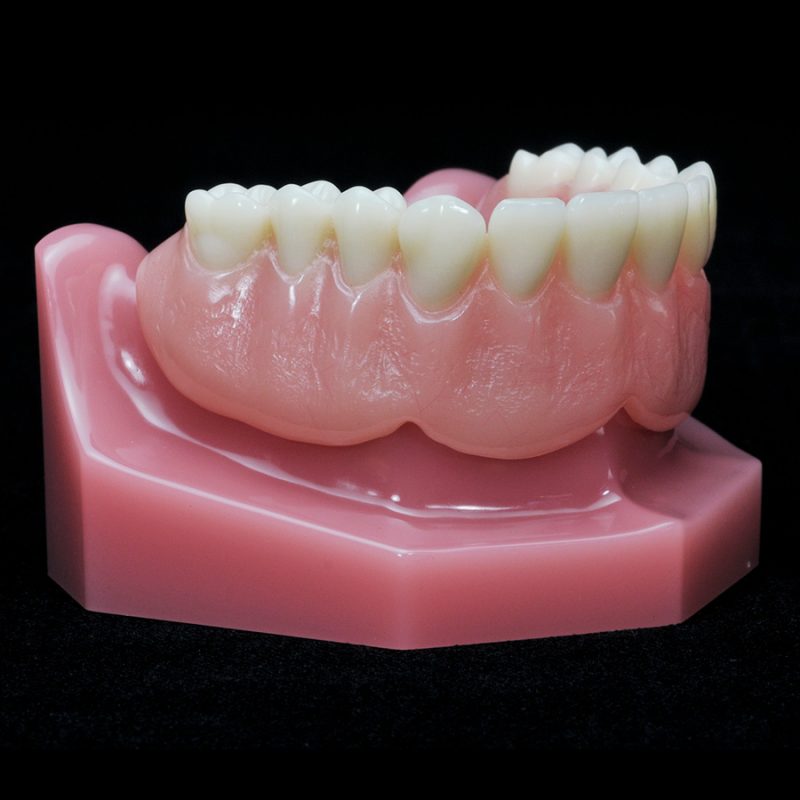 IM-15 Locator Horseshoe Overdenture | Paradigm Dental Models