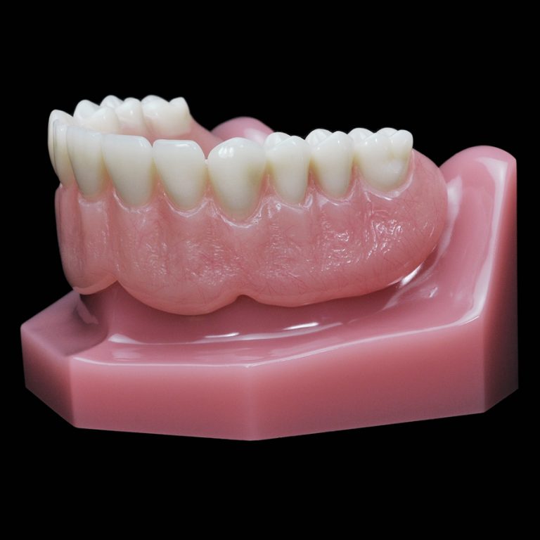 IM-15 Locator Horseshoe Overdenture | Paradigm Dental Models