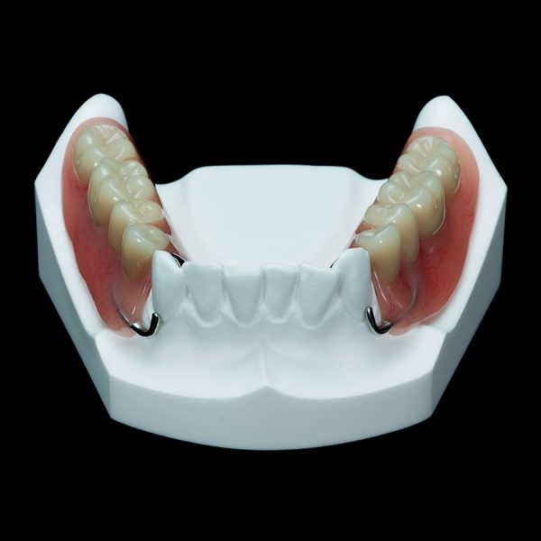 IM-20 Partial Mandible with 2 Locators | Paradigm Dental Models