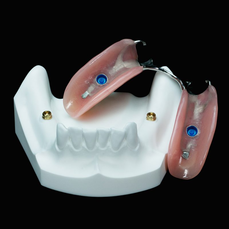 IM-20 Partial Mandible With 2 Locators | Paradigm Dental Models