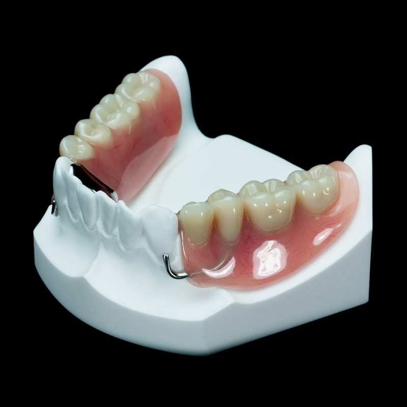 Im 20 partial mandible with 2 locators paradigm dental models