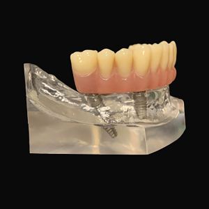 all in 4 dental implant