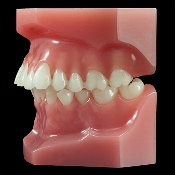 OR-08B Malocclusion Series:Class II Division 1 (Flexibase) Paradigm Dental Models