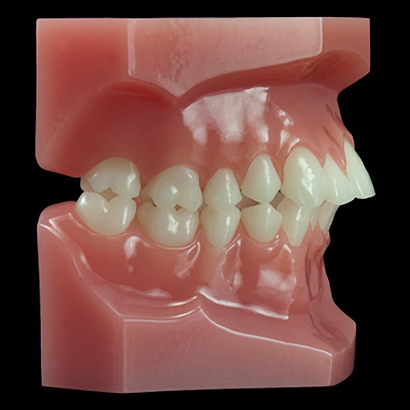 OR-08A Malocclusion Series:Class II Division 1 (Hard Base) Paradigm Dental Models