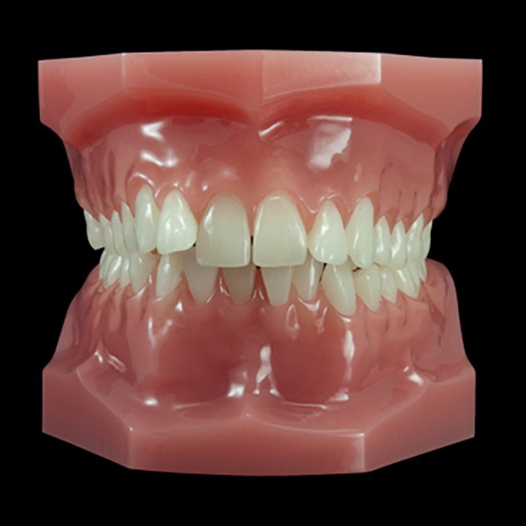 OR-09A Malocclusion Series:Class II Division 2 (Hard Base) | Paradigm ...