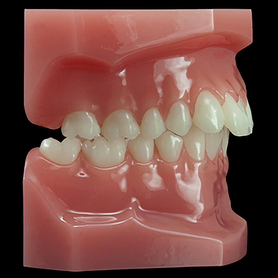 OR-09A Malocclusion Series:, Class II Division 2 (Hard Base)