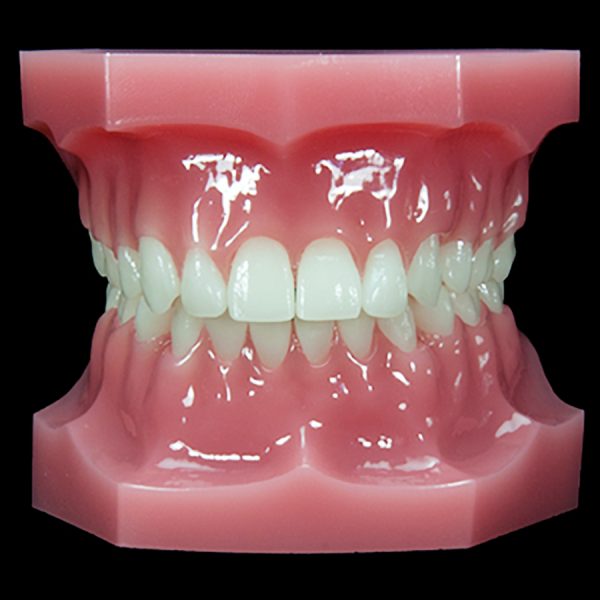 OR-12C Class II Div 1: Enmasse Retraction | Paradigm Dental Models