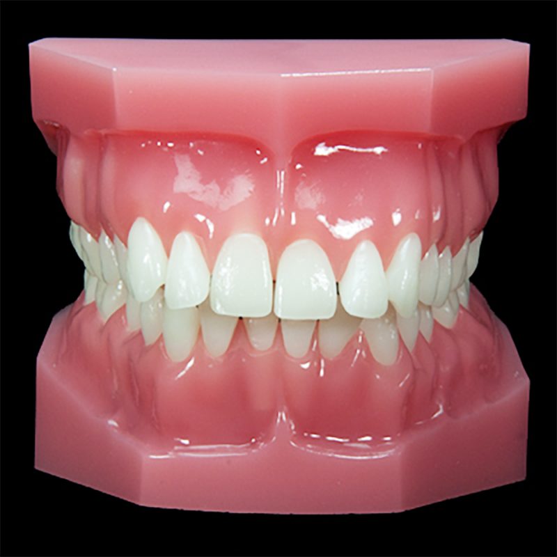 OR-13A Class II Div 1: Level and Align | Paradigm Dental Models