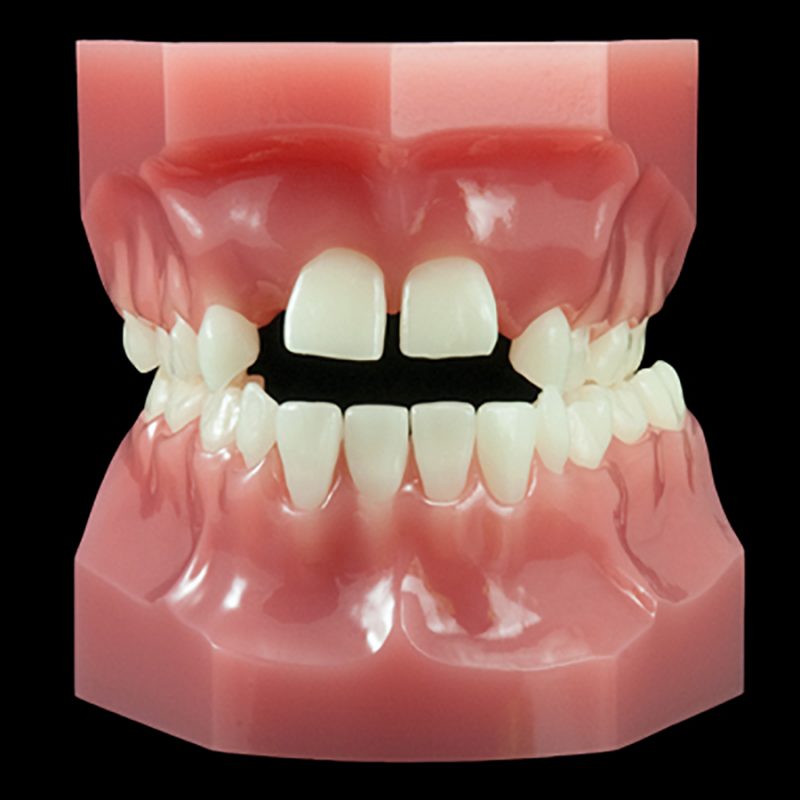 OR-17M Mixed Dentition:Class II Division 1 Blocked Cuspid (Flexibase