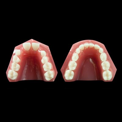 OR-17L Mixed Dentition:Class I Anterior Open Bite (Flexibase