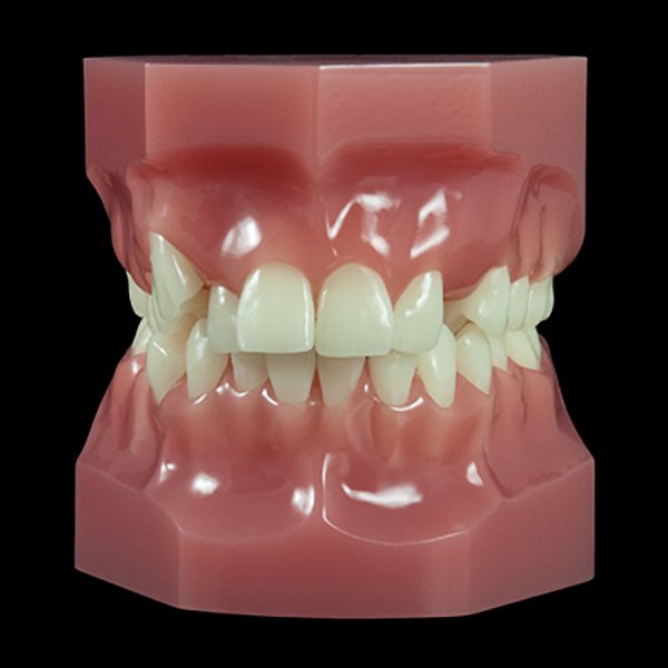 OR-17L Mixed Dentition:Class I Anterior Open Bite (Flexibase