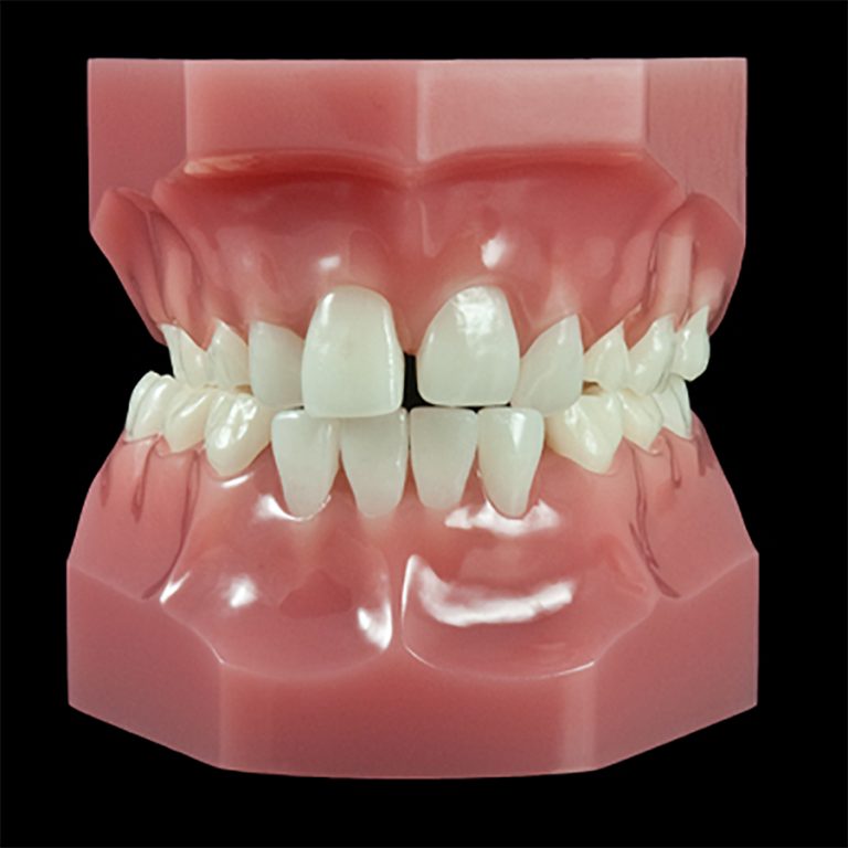 OR-17R Mixed Dentition:Class II Division 2 Permanent Dentition