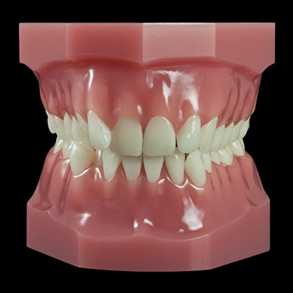 OR-17R Mixed Dentition:Class II Division 2 Permanent Dentition
