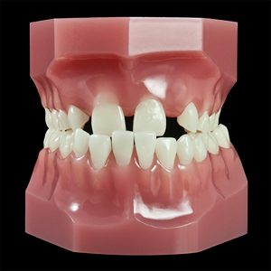OR-17S Mixed Dentition:Class III (Flexibase) | Paradigm Dental Models