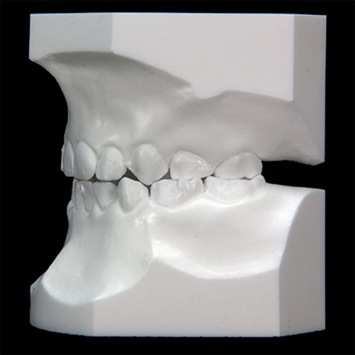 OR-18BW Pedo White: Crossbite | Paradigm Dental Models